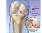 Triệu chứng của đứt dây chằng gối